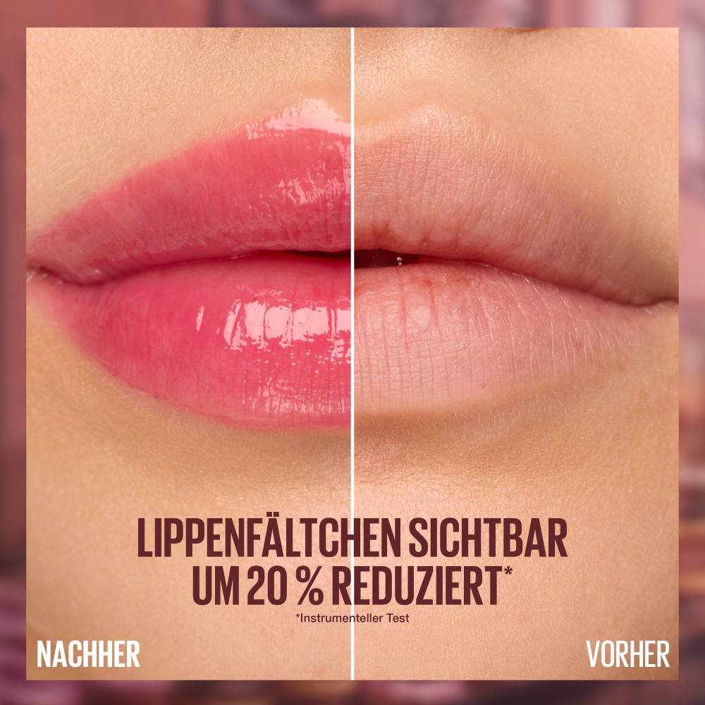 Vorher-Nachher-Vergleich zeigt die sichtbare Reduzierung von Lippenfältchen um 20 %